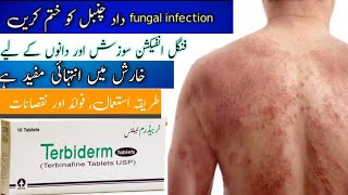 Terbiderm Tablets Uses In Urdu  Terbinafine  Anti Fungal Cream  Skin Infection  Terbiderm [upl. by Erland]