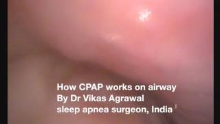 CPAP on snoring and sleep apnea how it actually works [upl. by Haonam630]