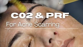 CO2 Laser and PRF Skincare Treatment Process [upl. by Inilam913]