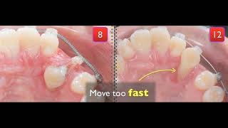 Treatment of palatal impaction [upl. by Erskine]