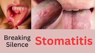 Breaking the Silence on Stomatitis  Understanding Stomatitis Causes Symptoms and Treatment [upl. by Yve]