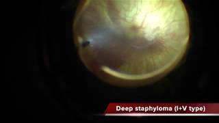 Myopic Foveoschisis with deep staphyloma [upl. by Nnilsia956]