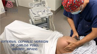 EXTERNAL CEPHALIC VERSION for BREECH BABY An option for achieving a safe vaginal delivery [upl. by Naicul525]