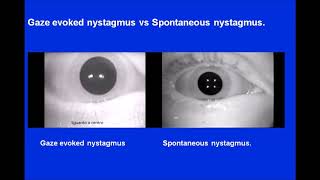 Gaze Nystagmus vs Spontaneous Nystagmus [upl. by Argyle]