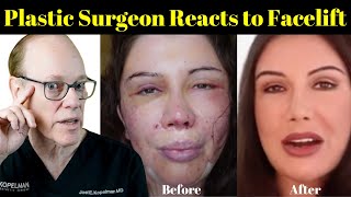 Plastic Surgeon Reacts  Lorry Hills Facelift Before amp After [upl. by Odrautse]