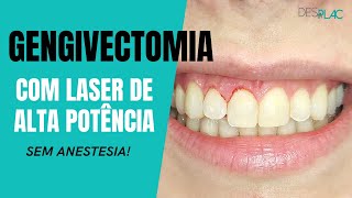 GENGIVECTOMIA COM LASER DE ALTA POTÊNCIA E SEM ANESTESIA [upl. by Atinahc]