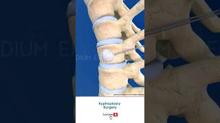 Spine Fracture Kyphoplasty ↪ 3D Medical Animation Shorts Kyphoplasty KyphoplastySurgery Spine [upl. by Edualcnaej323]