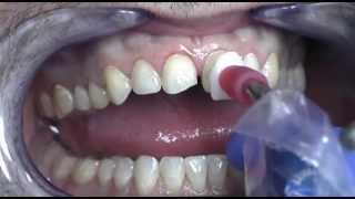 Prepless Veneers Procedure at Cosmetic Dental Associates San Antonio TX Dental Practice [upl. by Nobell]