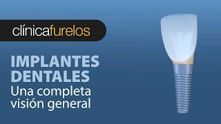 Una completa visión general de los implantes dentales [upl. by Ahsietal796]