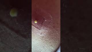 Acne Removal Treatment 2022  Best Pimple Popping video ever [upl. by Cram740]