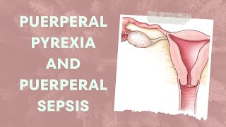 Understanding Puerperal Pyrexia and Puerperal Sepsis Causes Symptoms and Treatment [upl. by Sueddaht672]