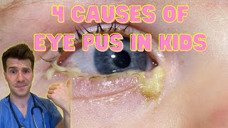 Doctor explains 4 causes of eye pus discharge or sticky eyes in kids  Doctor ODonovan [upl. by Aneetak]