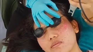 SALON LASER LAI CHI KOK B1 HONGKONG SL SKIN BEAUTY ATASI FLEK HITAM BEKAS JERAWAT [upl. by Rosel403]