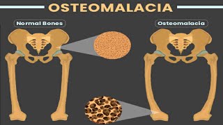 OSTEOMALACIA [upl. by Leyes719]