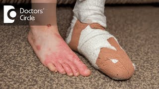 How to treat burns and burn marks in toddlers  Dr Ashok B C [upl. by Yim566]