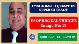 ESOPHAGEAL VARICES  Upper GI Tract Image Based Question [upl. by Eltsirhc739]