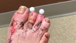 Removing pins from foot  Dr Nicholas Campitelli [upl. by Tymes913]