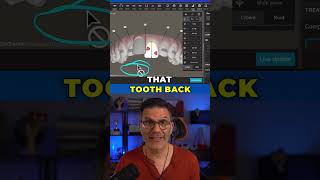 How to make teeth unmovable in the Invisalign ClinCheck software [upl. by Cosette585]