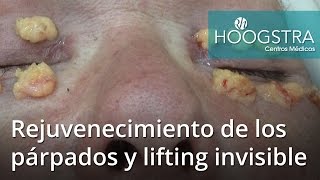 Rejuvenecimiento de los párpados y lifting invisible 16155 [upl. by Groves]