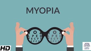 Myopia Signs and Symptoms Causes Diagnosis and Treatment [upl. by Elon]