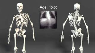 3D Scoliosis Animation [upl. by Oranneg]