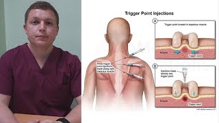 Блокада триггерных точек  Trigger Point Injection [upl. by Nylirak57]