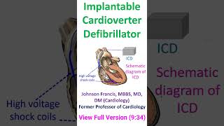 Implantable Cardioverter Defibrillator [upl. by Yrome]