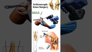 Arthroscopic Knee Surgery medical animation 3d short BiologywithAliya [upl. by Hplar]