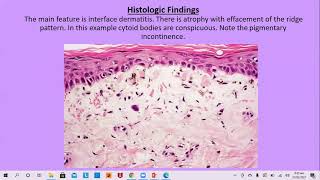 Lecture65 Dermatomyositis Rooks chapter 53 [upl. by Aldora]