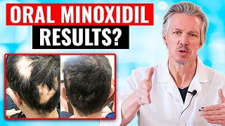 20000 PEOPLE TOOK ORAL MINOXIDIL AND THIS HAPPENED [upl. by Asile]