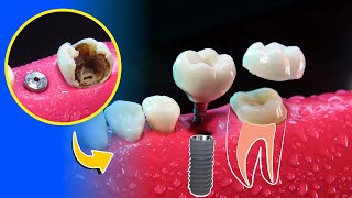 ¿Qué es mejor una endodoncia o un implante [upl. by Abagail]