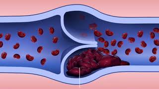 Patofisiologi Gangguan Sistem Kardiovaskular  Penyakit Varises dan Deep Vein Trombosis [upl. by Lalittah]