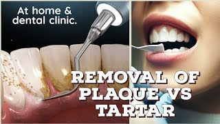 Removal of Tartar vs plaque at home and clinicDental scaling Plaque vs Calculus plaqueremoval [upl. by Ronna]