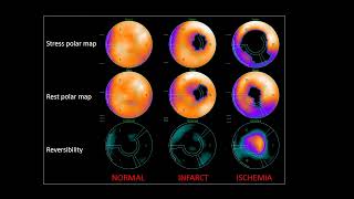 Nucradsharewordpresscom HOW TO READ MYOCARDIAL PERFUSION SCAN [upl. by Annot]