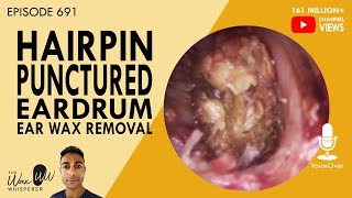 691  HAIRPIN Punctured Eardrum Ear Wax Removal [upl. by Nylatsirhc378]