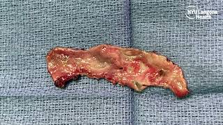 SP Robotic Diverticulectomy  Bladder Mucosa Urethroplasty [upl. by Barnie]