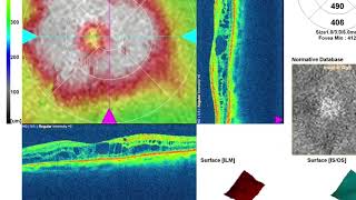 UGC Uveitis Glaucoma and cystoid macular edema Complications of a cataract surgery [upl. by Garrot100]