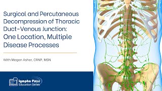 Surgical and Percutaneous Decompression of Thoracic DuctVenous Junction  Megan Asher CRNP MSN [upl. by Pavia]