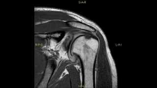 Retroversion of the glenoïd  complete MRI examination [upl. by Harrus]