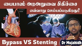 Stenting vs Bypass surgery in tamil  Bypass surgery எவ்வாறு செய்யப்படுகிறது Dr Mujahidh [upl. by Aliet36]