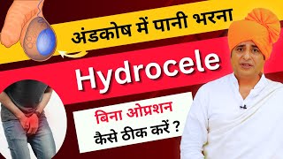 अंडकोष में पानी भरना Hydrocele बिना ओप्रशन कैसे ठीक करें  Sanyasi Ayurveda [upl. by Jilly]