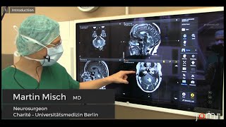 Brain Biopsy of a Suspected Cerebellar Lymphoma by Martin Misch Dr med Links to Full Procedure [upl. by Ordnassela]