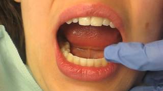 Dr Terry Tingey removing orthodontic braces [upl. by Arais]