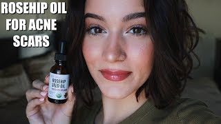 TRYING ROSEHIP OIL FOR A MONTH FOR ACNE SCARS [upl. by Edaw]