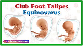 Club foot  Talipes equinovarus  Causes Symptoms Diagnosis and Treatment [upl. by Nnalyrehc228]