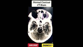 Normal Contrast CT Brain  Radiology [upl. by Hartmann]