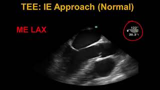 Transesophageal Echocardiography Infective Endocarditis [upl. by Conias737]