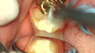 37 Full Zirconia Crown prep [upl. by Sivram]