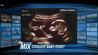 Baby Gives a ThumbsUp In Ultrasound Photo [upl. by Aninotna521]