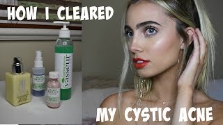 HOW I CLEARED MY CYSTIC ACNE Skincare Routine amp Tips [upl. by Ailaro]